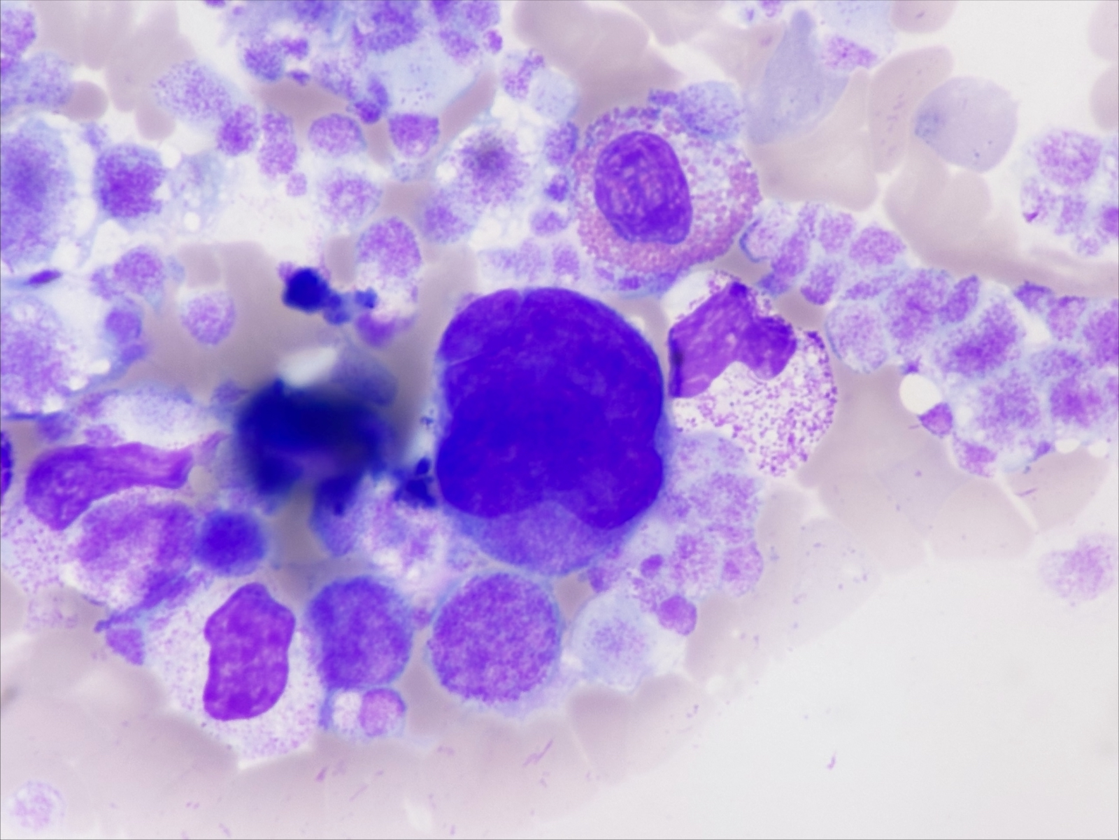 Cancer : inégalités sociales face aux risques graves