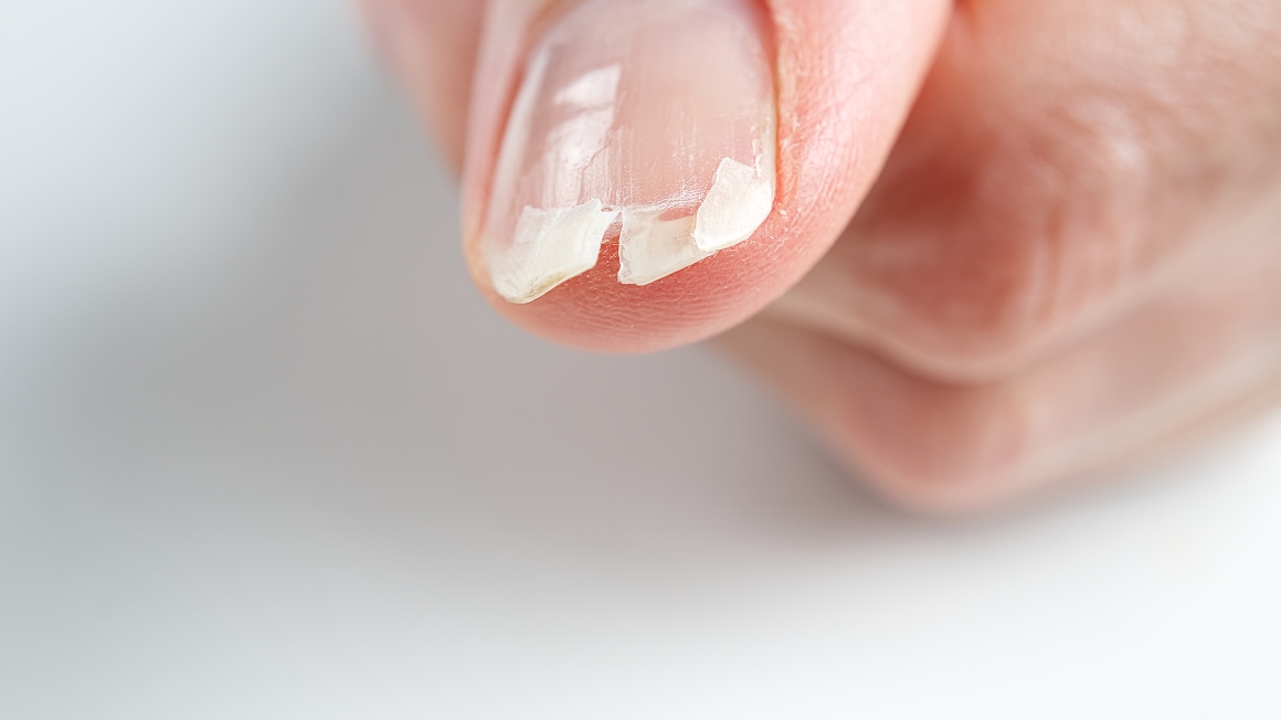 Ongles cassants : quelles sont les causes les plus fréquentes ?
