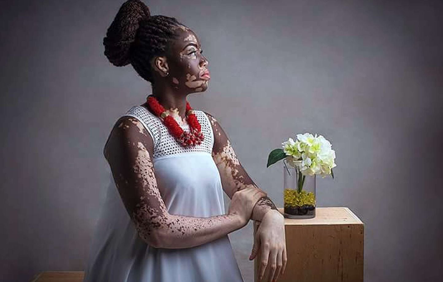 Nice : Pour la première fois, un traitement pour soigner le vitiligo est  validé et le CHU y a contribué