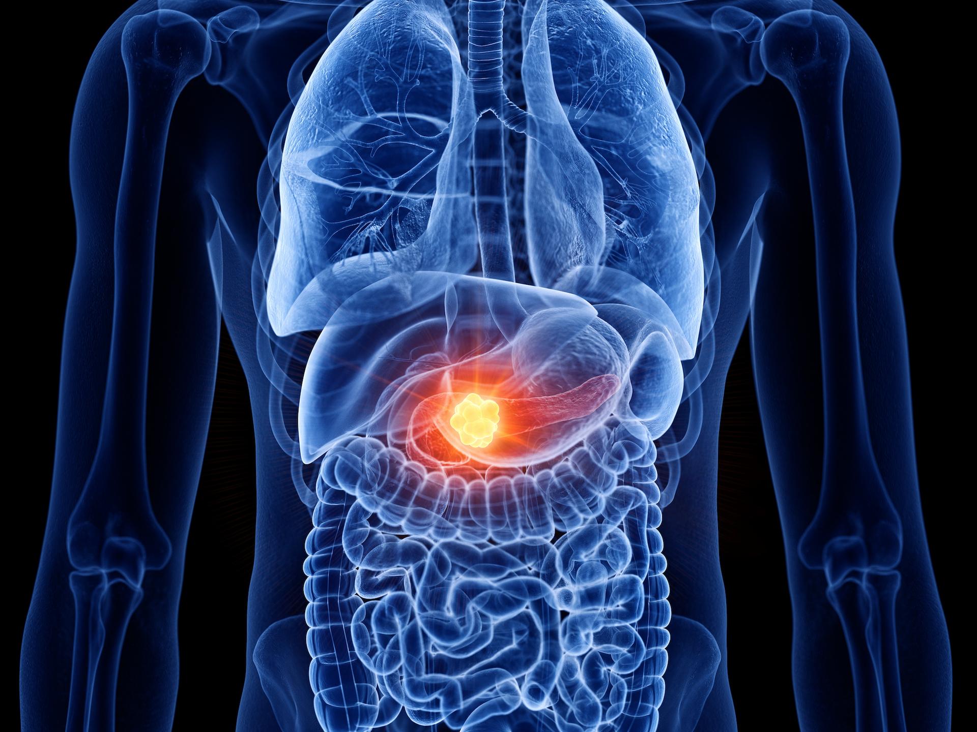 Espoir majeur dans le cancer du pancréas : un nouveau traitement double la  survie des patients à un an