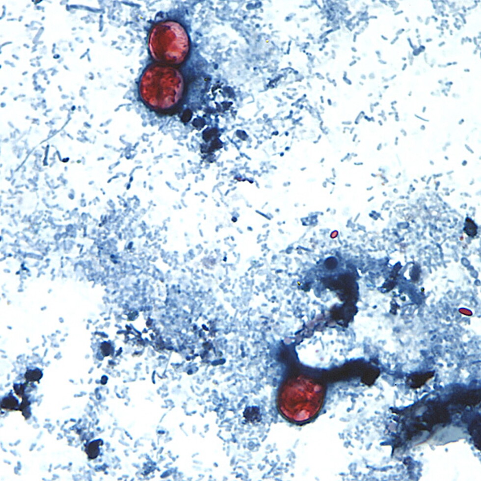 Cyclospora outbreak cases top 1,000 in Michigan and Ohio | AP News